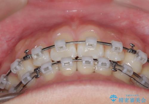 白い装置で八重歯を改善|抜歯矯正で見た目と噛み合わせ向上の治療中