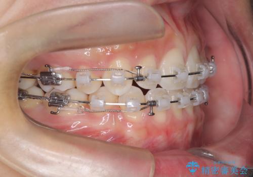 白い装置で八重歯を改善|抜歯矯正で見た目と噛み合わせ向上の治療中