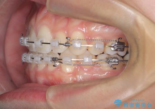白い装置で八重歯を改善|抜歯矯正で見た目と噛み合わせ向上の治療中