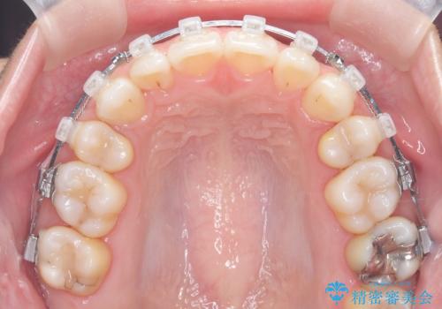 白い装置で八重歯を改善|抜歯矯正で見た目と噛み合わせ向上の治療中