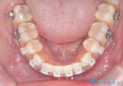 白い装置で八重歯を改善|抜歯矯正で見た目と噛み合わせ向上の治療中