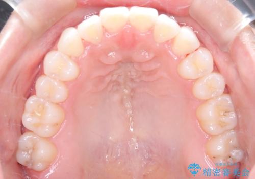 MARPEで非抜歯矯正|オープンバイトと八重歯を改善の治療後