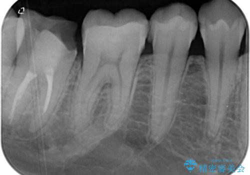 大きく歯が欠けた。 外科処置を行ったセラミック治療の治療前