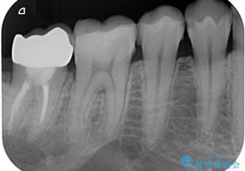 大きく歯が欠けた。 外科処置を行ったセラミック治療の治療後