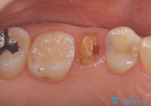 歯が取れた症例に対するセラミッククラウンによる修復の治療前