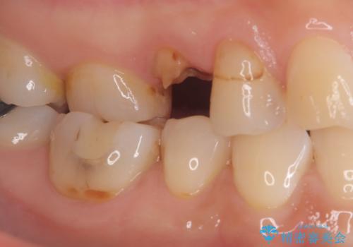 歯が取れた症例に対するセラミッククラウンによる修復の治療前