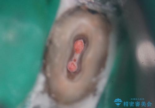 歯が取れた症例に対するセラミッククラウンによる修復の治療中