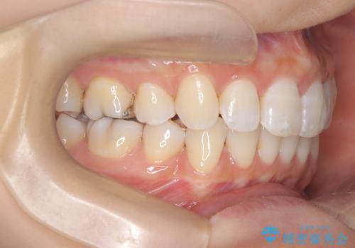 再び気になり始めた前歯のがたつき|インビザラインによる再矯正の治療後