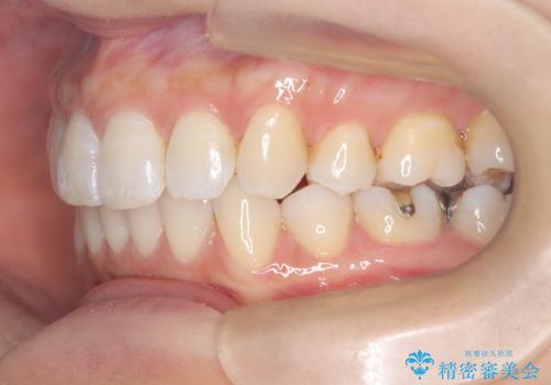 再び気になり始めた前歯のがたつき|インビザラインによる再矯正の治療後