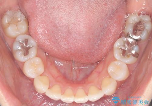 再び気になり始めた前歯のがたつき|インビザラインによる再矯正の治療後