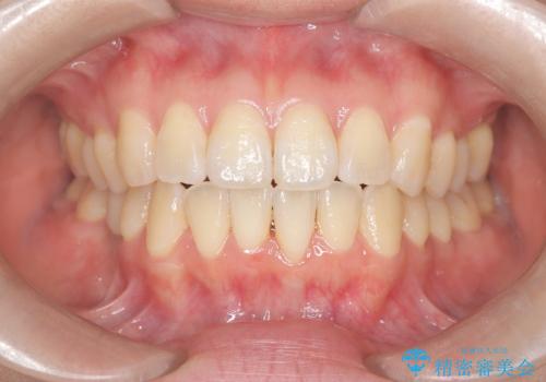 右下5番の先天欠如と前歯の叢生に対するワイヤー矯正とインプラント治療の治療後