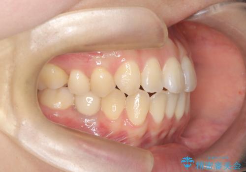 右下5番の先天欠如と前歯の叢生に対するワイヤー矯正とインプラント治療の治療後