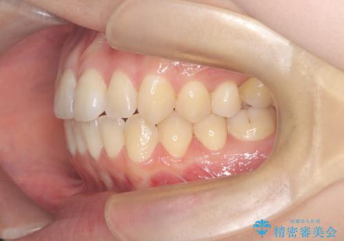 右下5番の先天欠如と前歯の叢生に対するワイヤー矯正とインプラント治療の治療後