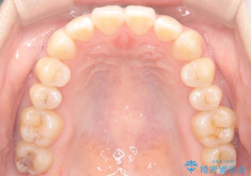右下5番の先天欠如と前歯の叢生に対するワイヤー矯正とインプラント治療の治療後