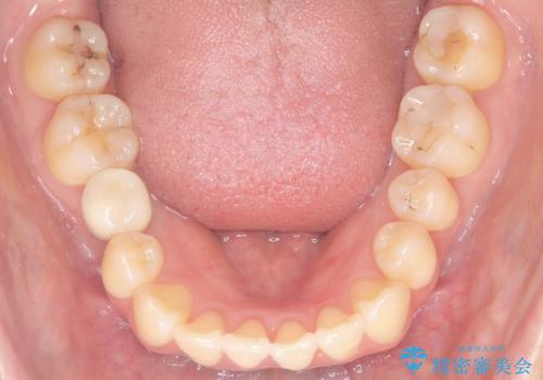 右下5番の先天欠如と前歯の叢生に対するワイヤー矯正とインプラント治療の治療後