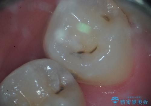 左下小臼歯|接触面カリエスに対するセラミックインレー修復の治療前