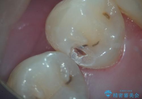 左下小臼歯|接触面カリエスに対するセラミックインレー修復の治療中
