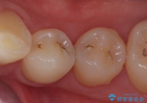 左下小臼歯|接触面カリエスに対するセラミックインレー修復の症例 治療前