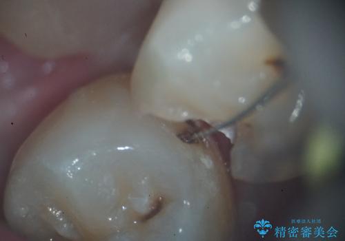 左下小臼歯|接触面カリエスに対するセラミックインレー修復の治療前