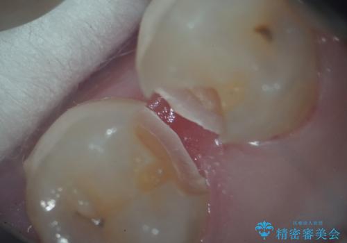 左下小臼歯|接触面カリエスに対するセラミックインレー修復の治療後