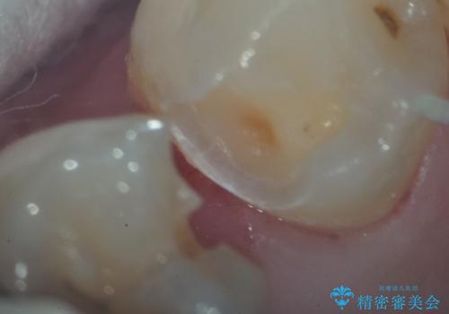 左下小臼歯|接触面カリエスに対するセラミックインレー修復の治療後