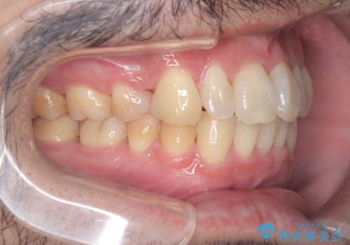 ハーフリンガル矯正による前歯部の叢生改善と口元の後退|上顎左右4番・下顎1番抜歯症例の治療後