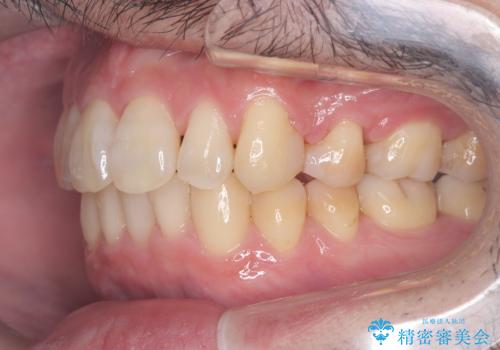 ハーフリンガル矯正による前歯部の叢生改善と口元の後退|上顎左右4番・下顎1番抜歯症例の治療後
