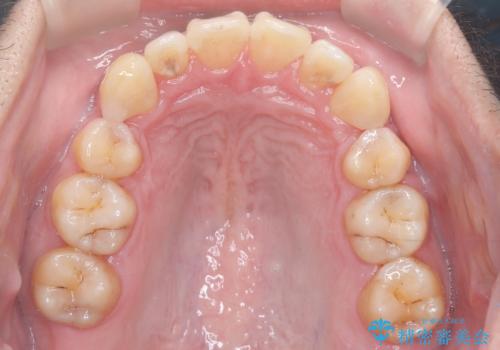 ハーフリンガル矯正による前歯部の叢生改善と口元の後退|上顎左右4番・下顎1番抜歯症例の治療後