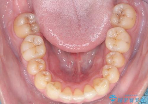 ハーフリンガル矯正による前歯部の叢生改善と口元の後退|上顎左右4番・下顎1番抜歯症例の治療後