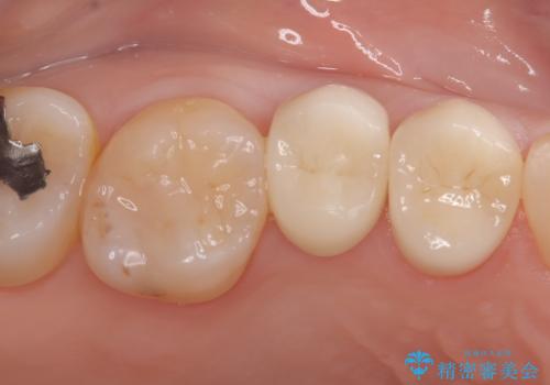 歯が取れた症例に対するセラミッククラウンによる修復の治療後