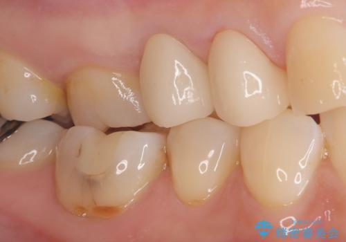 歯が取れた症例に対するセラミッククラウンによる修復の治療後
