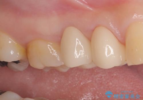 歯が取れた症例に対するセラミッククラウンによる修復の治療後