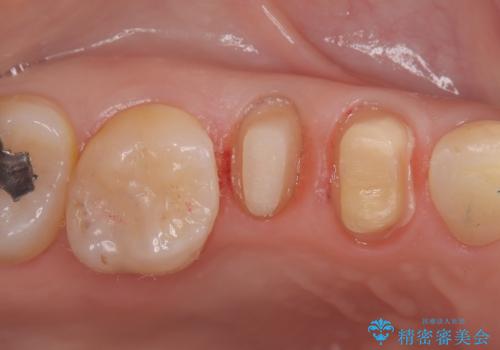 歯が取れた症例に対するセラミッククラウンによる修復の治療中
