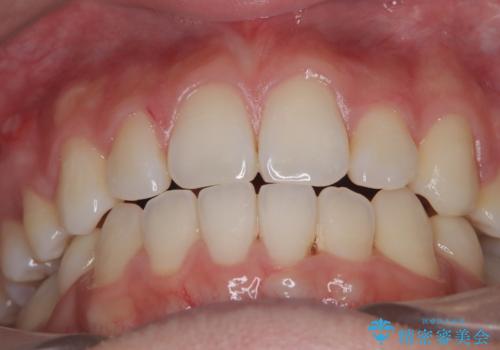 白い装置で八重歯を改善|抜歯矯正で見た目と噛み合わせ向上の治療後