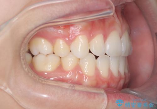 白い装置で八重歯を改善|抜歯矯正で見た目と噛み合わせ向上の治療後