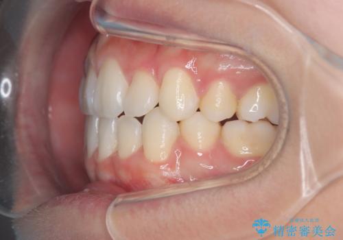 白い装置で八重歯を改善|抜歯矯正で見た目と噛み合わせ向上の治療後