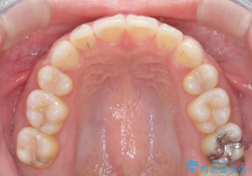 白い装置で八重歯を改善|抜歯矯正で見た目と噛み合わせ向上の治療後