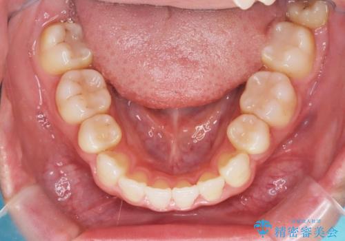 白い装置で八重歯を改善|抜歯矯正で見た目と噛み合わせ向上の治療後