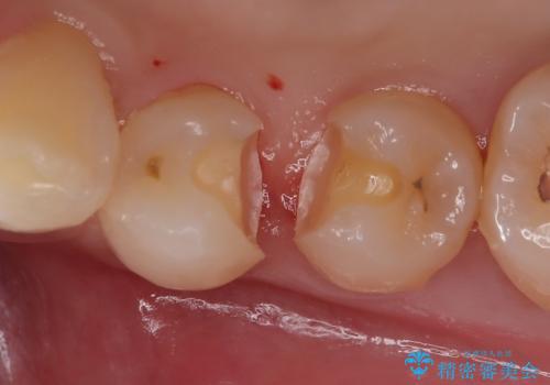 左下小臼歯|接触面カリエスに対するセラミックインレー修復の治療中