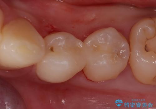 左下小臼歯|接触面カリエスに対するセラミックインレー修復の症例 治療後