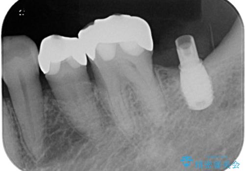 インプラント治療を含む精密審美治療の治療中