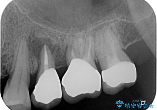 インプラント治療を含む精密審美治療の治療後
