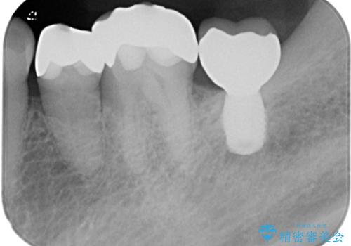 インプラント治療を含む精密審美治療の治療後