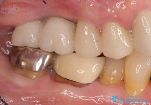 ブリッジのぐらつき インプラントを用いた奥歯の噛み合わせの再構築の治療後
