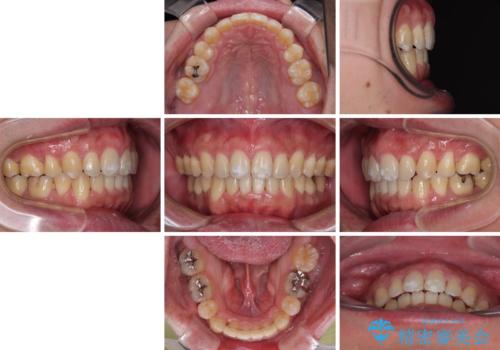 口が閉じられない 抜歯矯正で前歯の突出感を改善の治療後