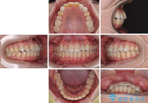 むし歯と八重歯を治したい 総合歯科治療の治療後