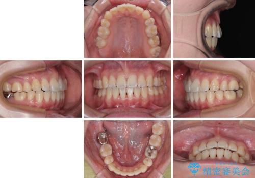 【モニター】口が閉じられない ワイヤー装置での抜歯矯正の治療後