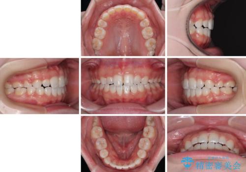 【モニター】舌突出癖で隙間が ワイヤー装置での抜歯矯正の治療後
