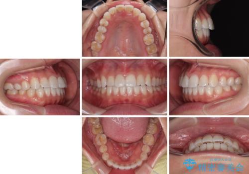 捻れた前歯を楽して改善 ワイヤー装置での非抜歯矯正の治療後