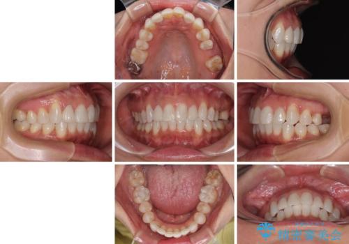 前歯のデコボコとむし歯治療の跡 インビザライン矯正とオールセラミッククラウン治療の治療後